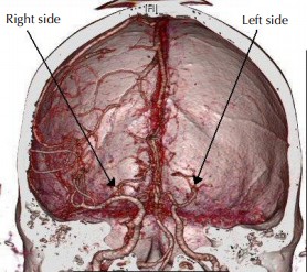 CT angiogram