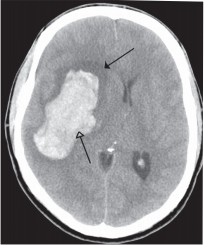 Right capsular intracerebral haemorrhage 