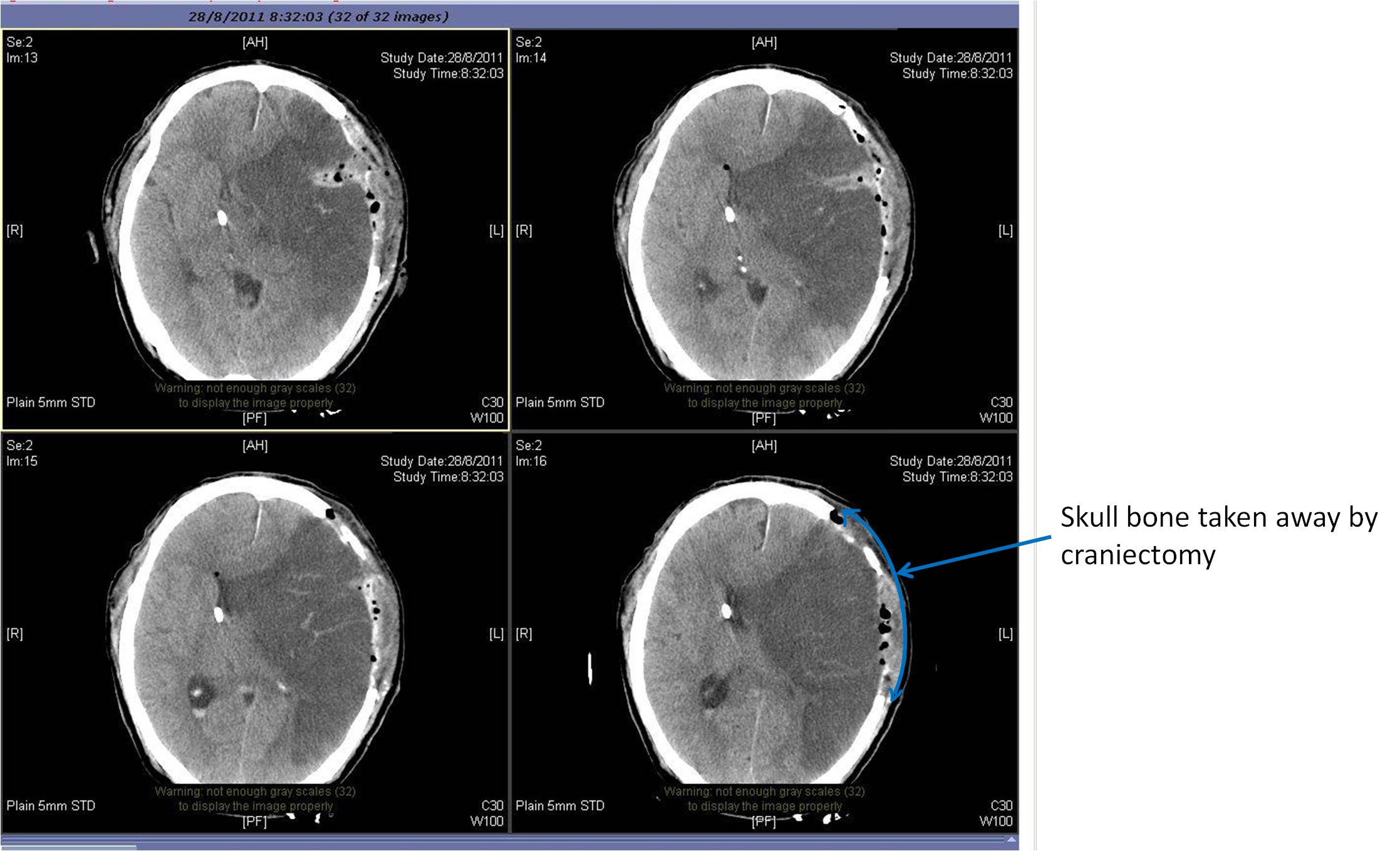  Left sided decompressive craniectomy