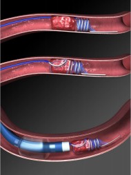 The Merci Clot retriever for mechanical thrombectomy