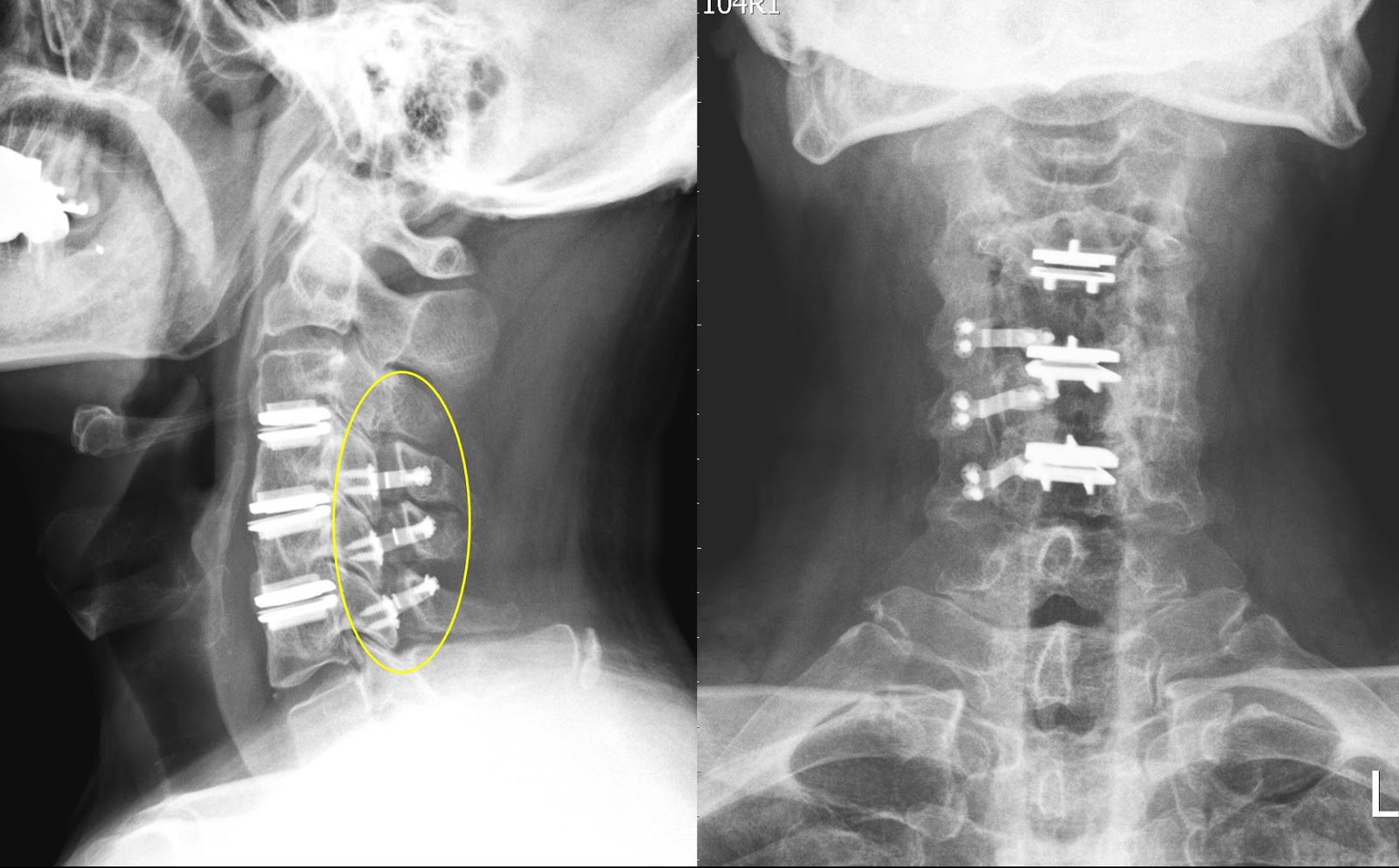 脊椎骨上放入金屬板(支架、鏍絲及骨板)以鞏固植骨