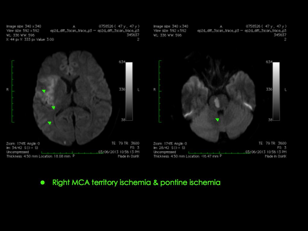 Middle Cerebral Artery MCA
