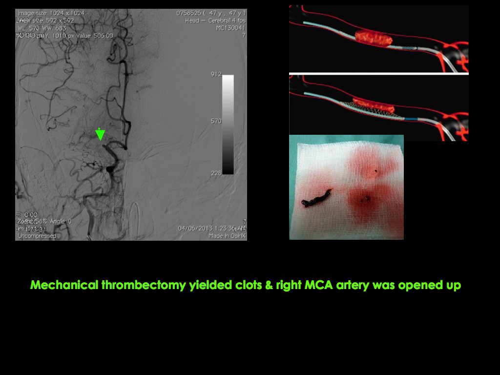 middle-cerebral-artery-MCA3