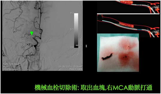 middle-cerebral-artery-MCA3