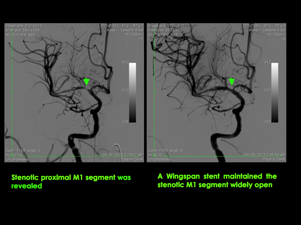 middle-cerebral-artery-MCA6