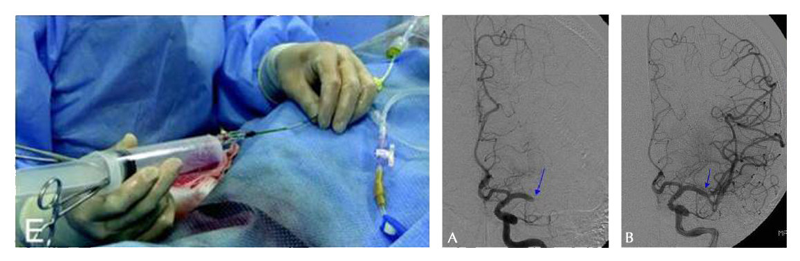 Pretreatment Angiography