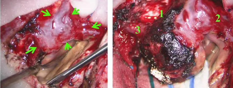Severe hemorrhagic stroke caused by rupture of congenital cerebral Arteriovenous Malformation (AVM)