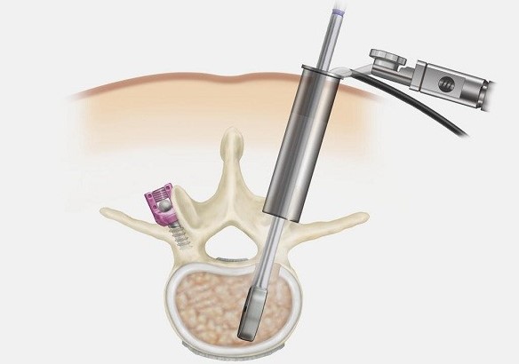 Minimally Invasive Spine Surgery