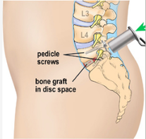 Minimally Invasive Spine Surgery