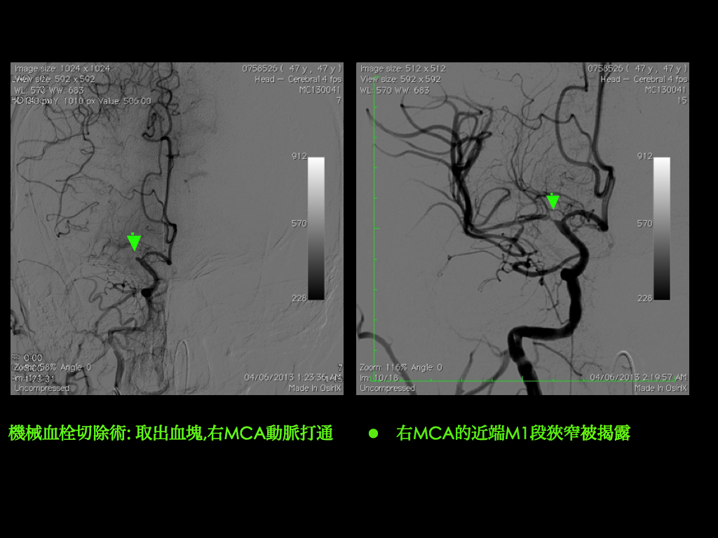 機械血栓切除手術