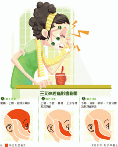 三叉神經痛影響範圍