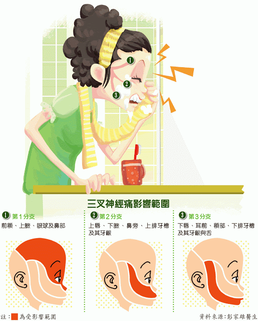 三叉神經痛影響範圍