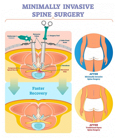 Minimally Invasive Spine Surgery