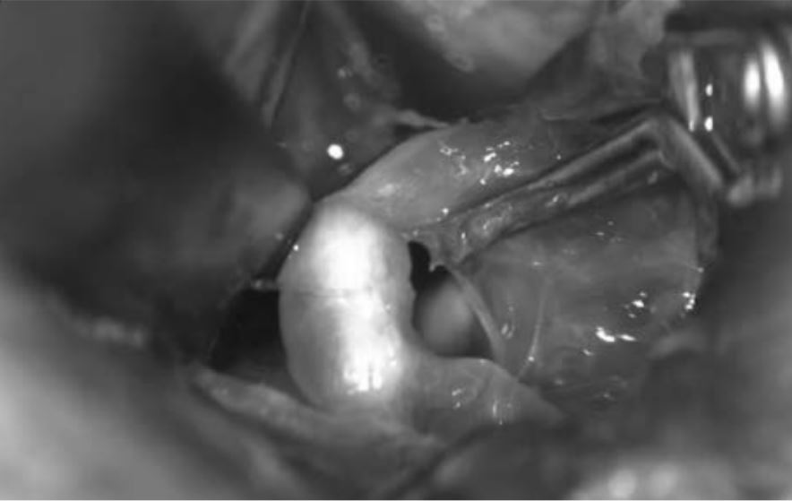 after endovascular therapy