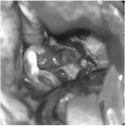 before-endovascular-therapy