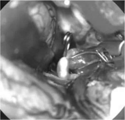 endovascular-therapy-in-progress