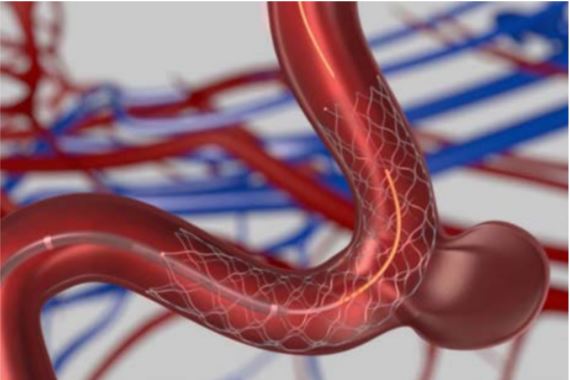 endovascular therapy