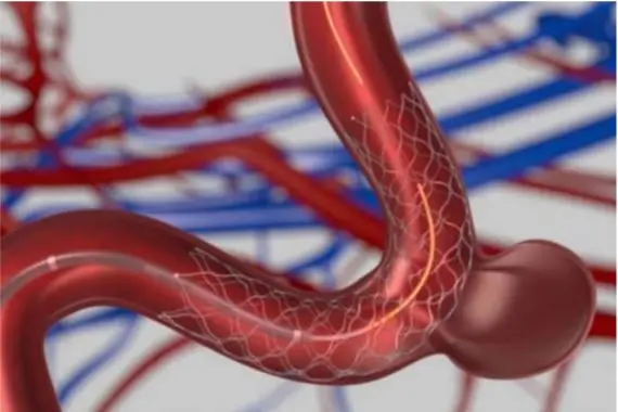 黃小姐腦內的計時炸彈拆除，改變了將來衍生出血性中風的命運