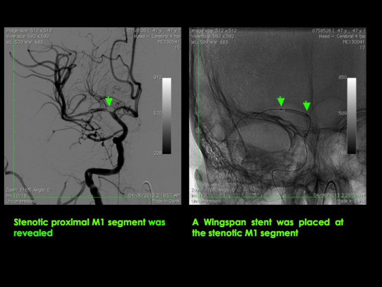 Middle Cerebral Artery - MCA5