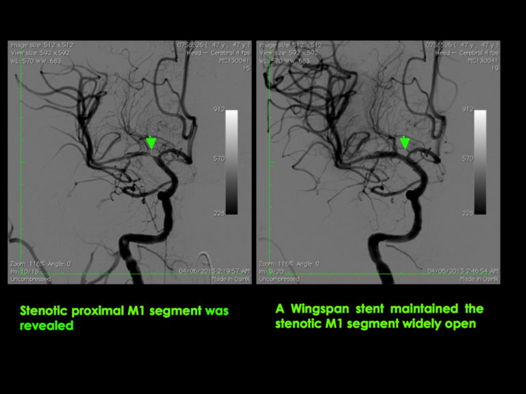 Middle Cerebral Artery - MCA6