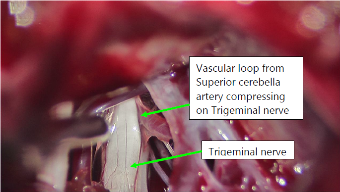 trigeminal nerve surgery