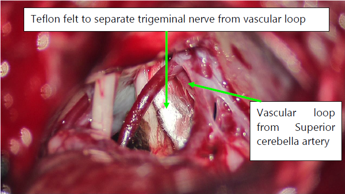 trigeminal nerve surgery