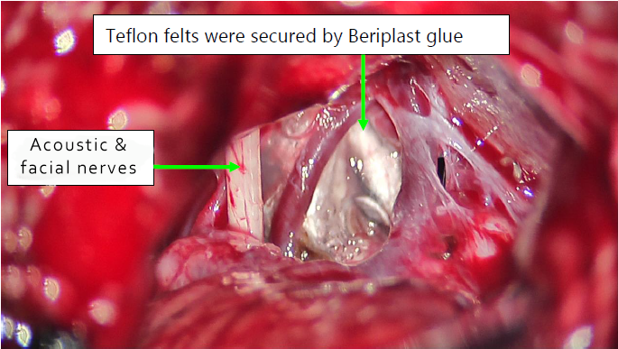 trigeminal nerve surgery