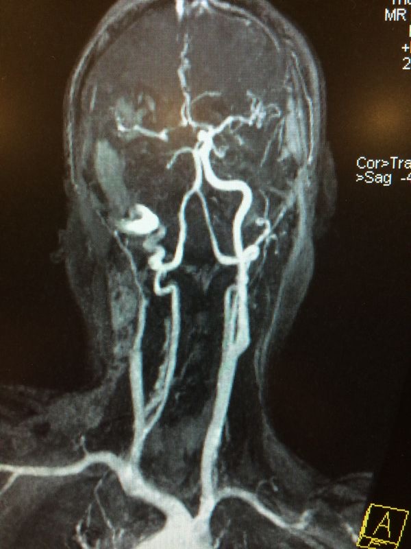 右邊頸和腦部血管大動脈全部都被血栓堵塞
