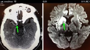 右邊大腦缺血水腫，導致左邊手腳冇力和神智半昏迷
