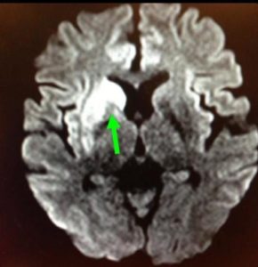 右邊大腦缺血水腫，導致左邊手腳冇力和神智半昏迷