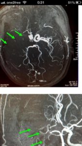 右邊頸和腦部血管大動脈全部都被血栓堵塞着
