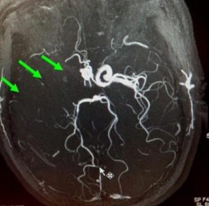 右邊頸和腦部血管大動脈全部都被血栓堵塞着