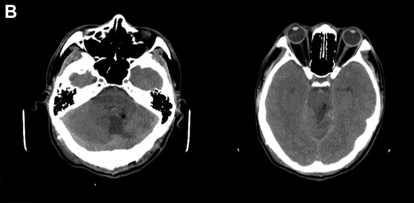 術後電腦掃瞄影