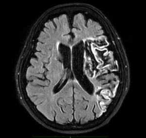 李太左邊大腦血管完全栓塞，導致左腦大範圍缺血中風逐漸壞死