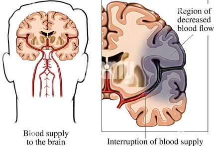 ischemic-stroke