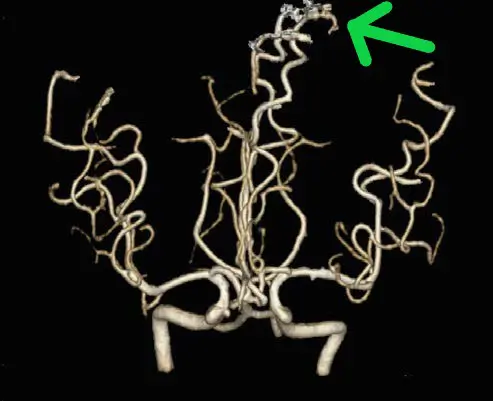三維立體腦血管造影顯示，左邊大腦有先天性的腦血管動靜脈畸形血管瘤