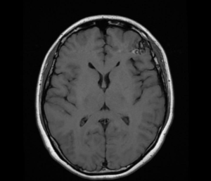 HKBSSP AVM-MRI-4