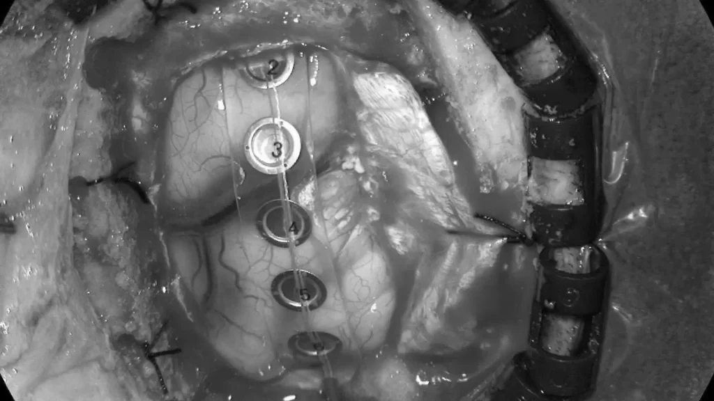 使用运动皮层映射和连续脑功能监测系统进行手术