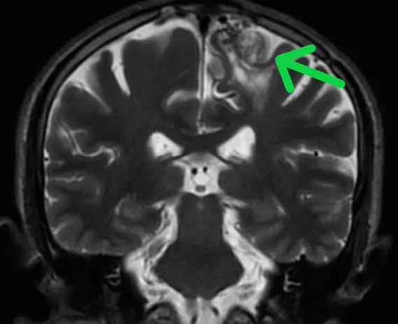 The 3D cerebral angiography revealed that there was a congenital Cerebrovascular Arteriovenous Malformations (AVM) on left side of the brain