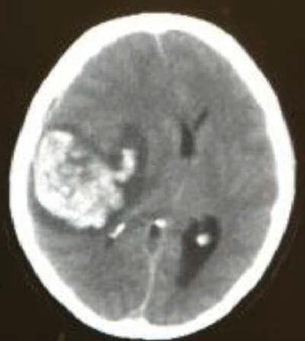 HKBSSP-AVM-MRI