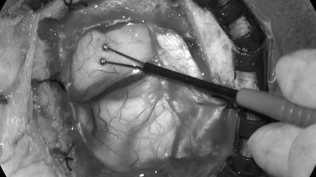 使用运动皮层映射和连续脑功能监测系统进行手术