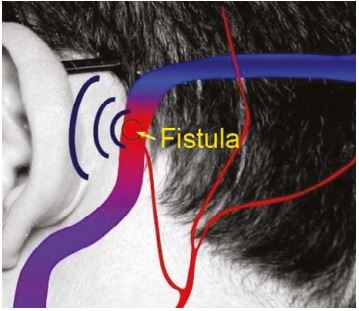 Fistula