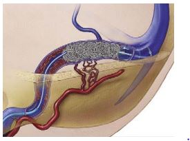 利用鈦金屬絲線圈去堵塞不正常靜脈竇和腦動脈的重疊交 替，堵截不正常血液交叉流動。