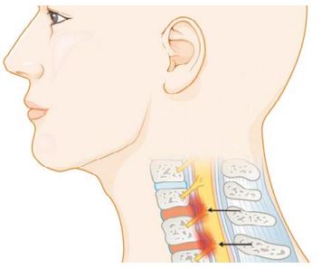 頸椎間盤突出而擠壓到脊髓中樞神經