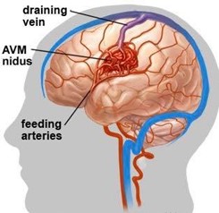 Severe hemorrhagic stroke caused by rupture of congenital cerebral Arteriovenous Malformation (AVM)