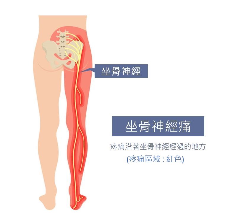 坐骨神經痛