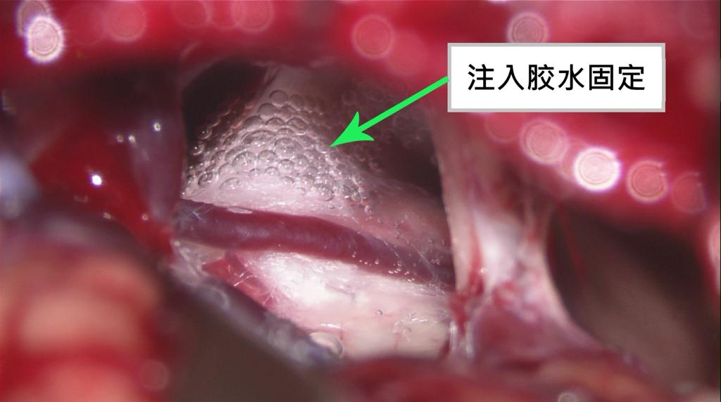 三叉神經痛-3-20231206