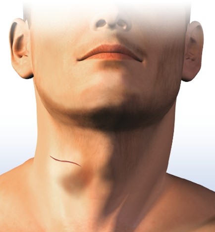 非微創傳統手術2