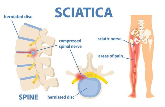 Sciatica-HKBSSP