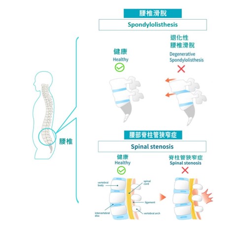 Spinal Stenosis HKBSSP